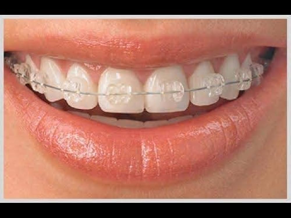 Metro Orthodontics Purple Series Pack of 20 Ceramic Conventional Brackets - Global Surgicals