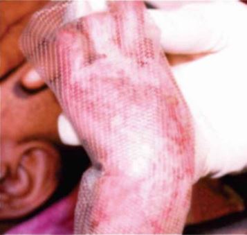 Surgiwear Non - Stick Mesh - Global Surgicals