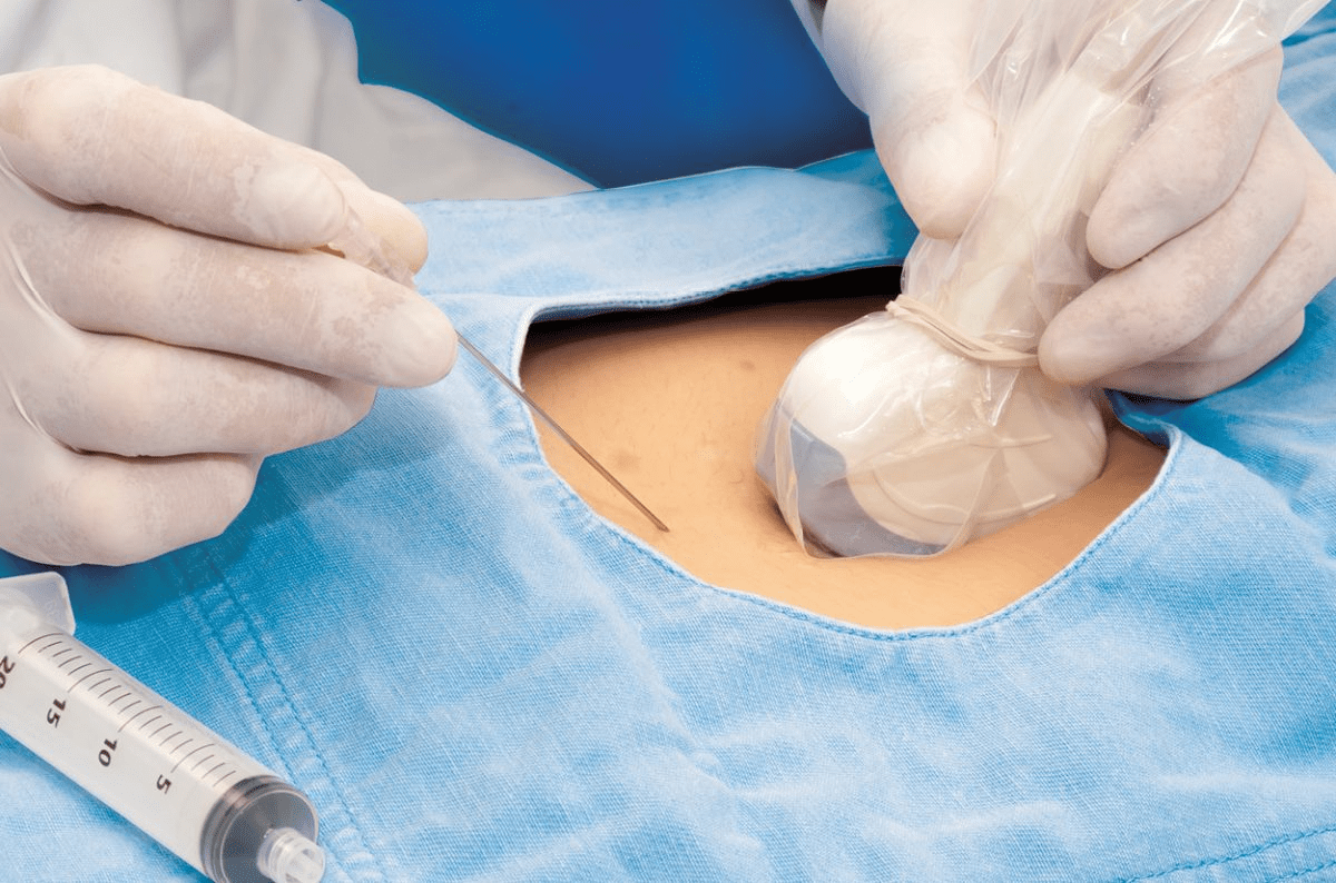 Surgiwear Ultrasound Drape - Global Surgicals